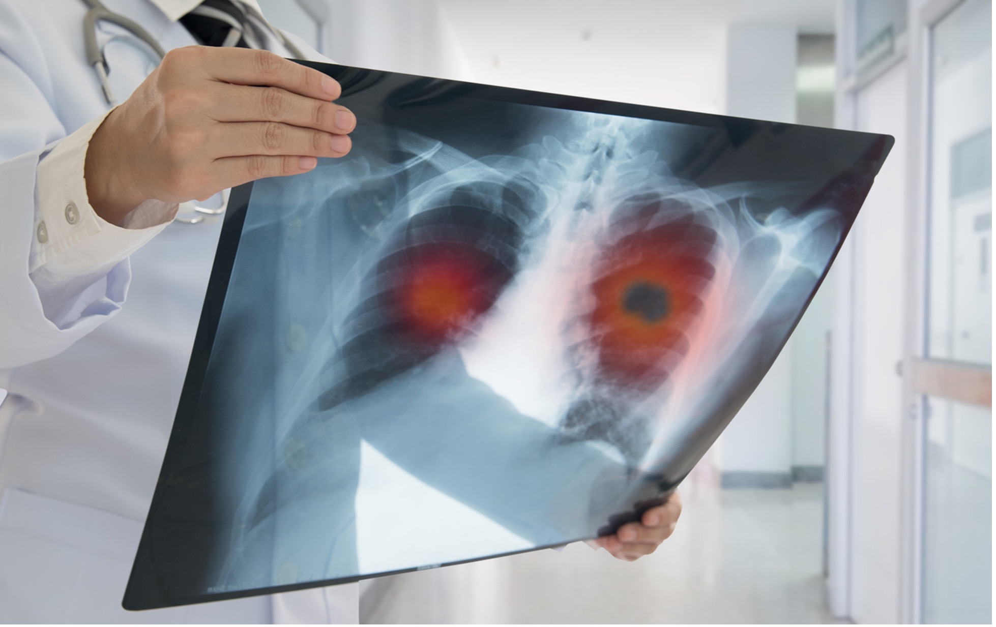 Have You Been Diagnosed With Lung Cancer?