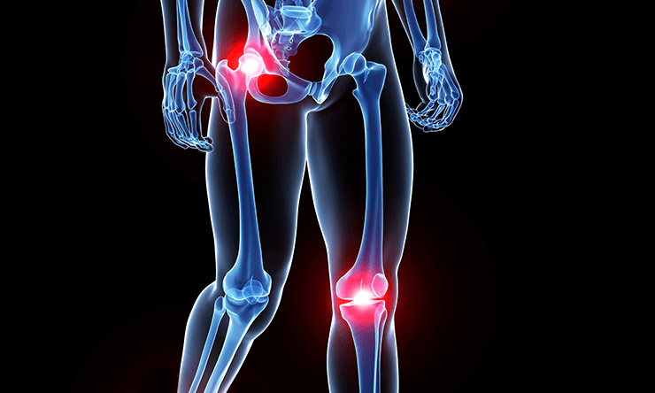 Did you have a knee, ankle, or hip replacement surgery?